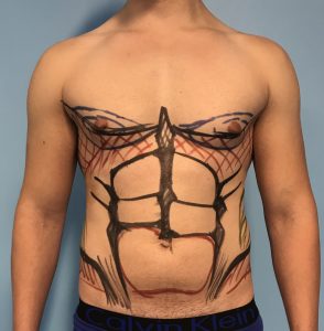 Diseño Preoperatorio VaserLipo Hombre mediante códigos de colores podemos guiarnos después en la intervención