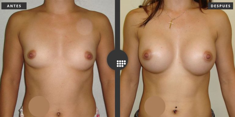 Aumento de Pecho