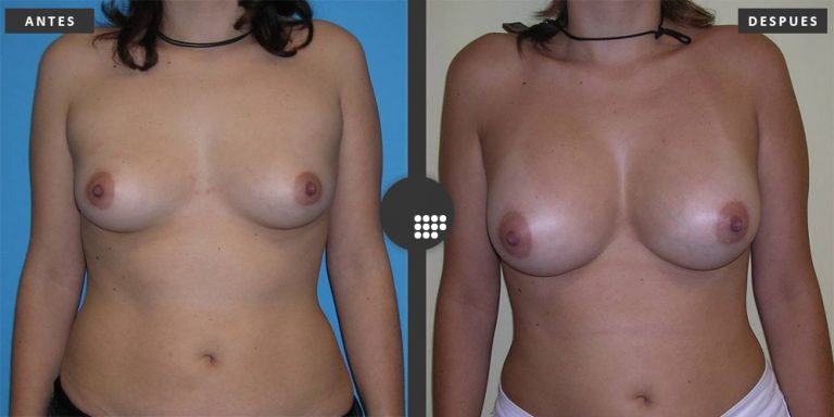 Aumento de Pecho