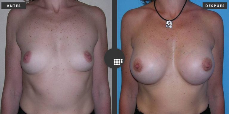 Aumento de Pecho