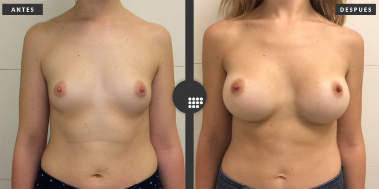 Aumento de Pecho