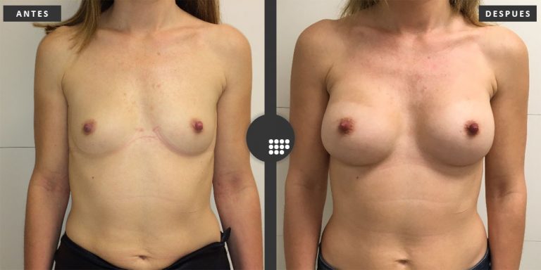 Aumento de Pecho